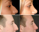 Video Gewoon mooier: neuscorrectie en injectable in het gezicht